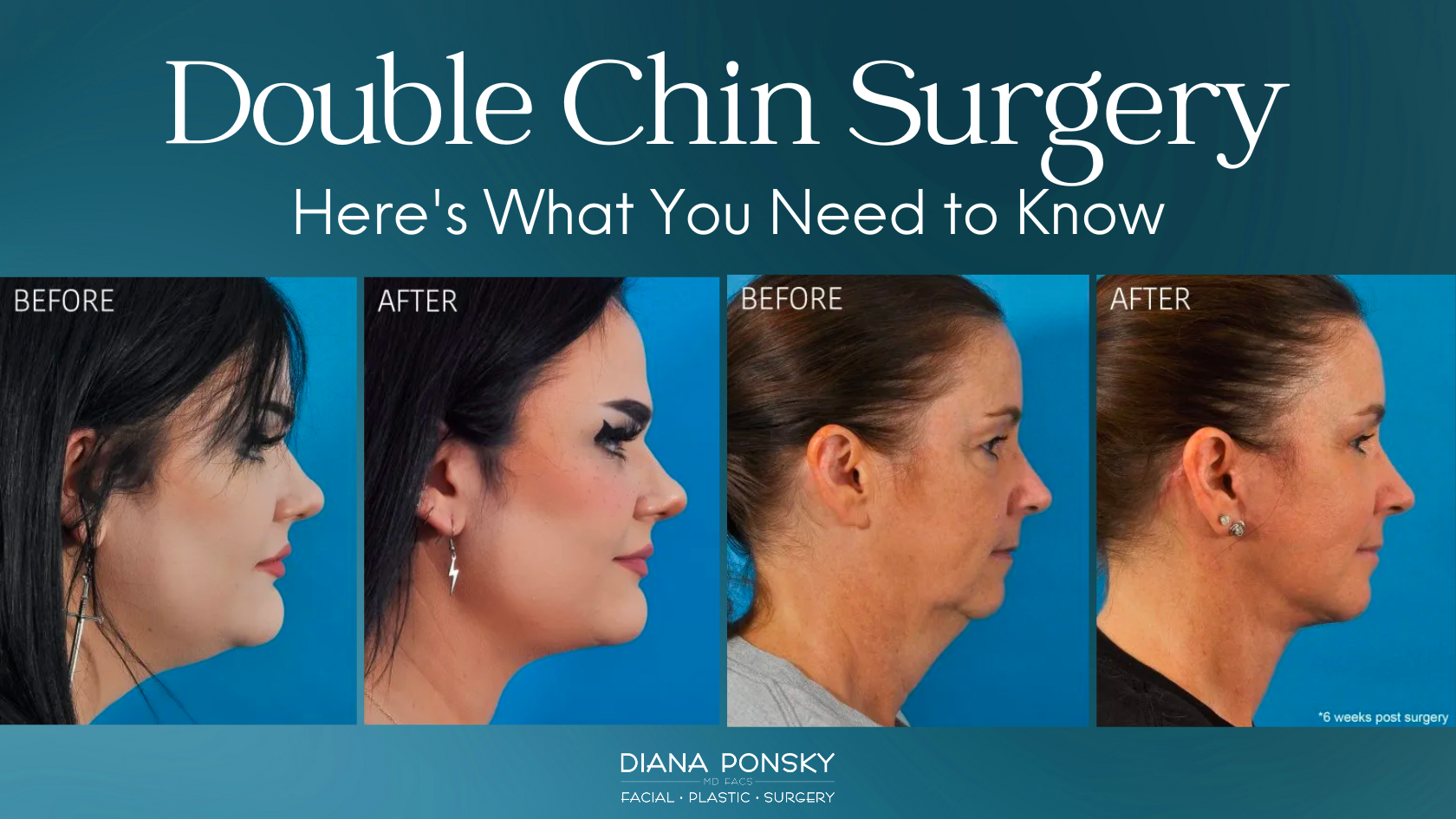chin plastic surgery chin plastic surgery