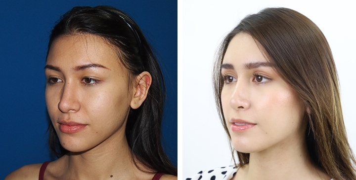 chin reduction chin reduction