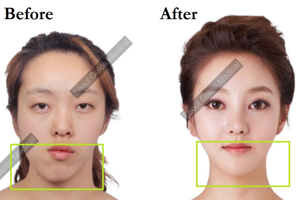chin reduction chin reduction