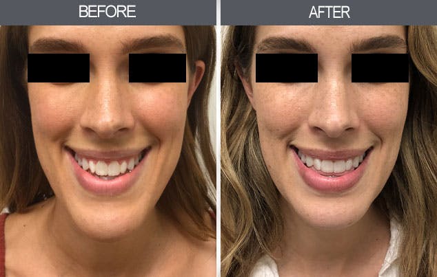 chin reduction chin reduction