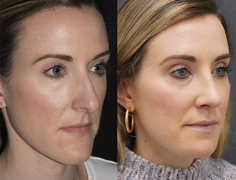 Chin reduction: Refining facial proportions with precision