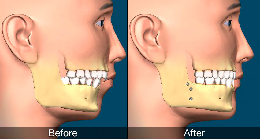 chin surgery chin surgery