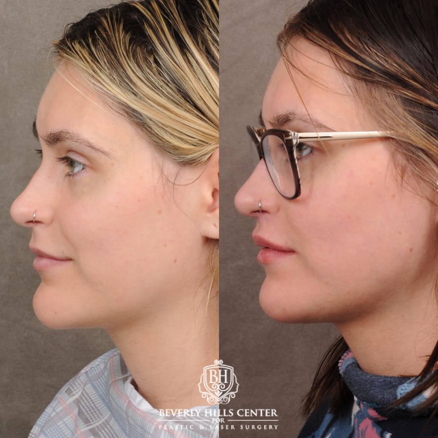chin surgery chin surgery
