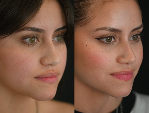 chin surgery chin surgery