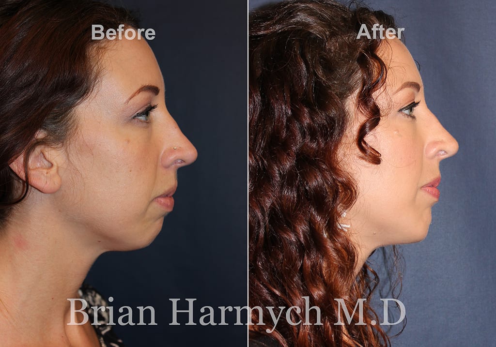 chin surgery chin surgery