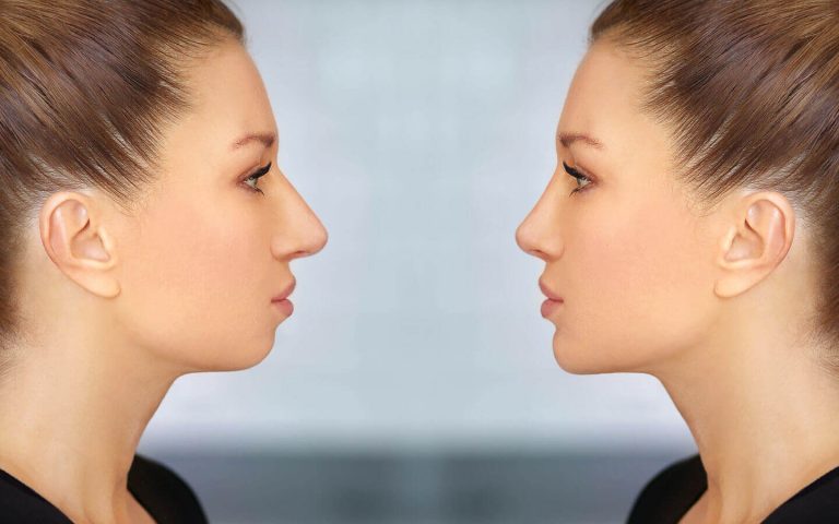 Chin surgery: Enhancing definition and symmetry