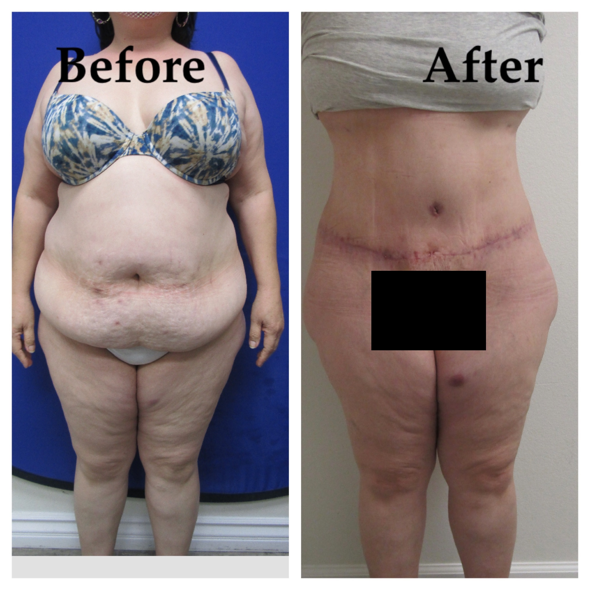 circular tummy tuck