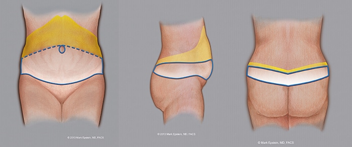 Circular Tummy Tuck: Unique Approaches to Abdominal Contouring