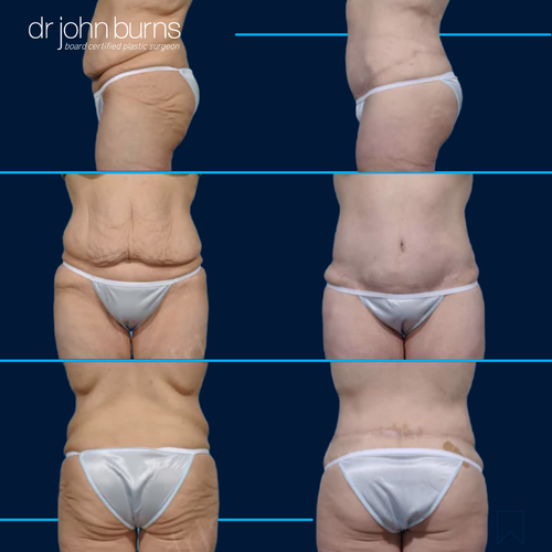 circular tummy tuck