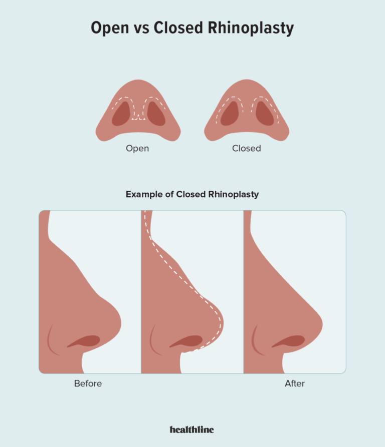Closed Rhinoplasty: A less invasive nose surgery option