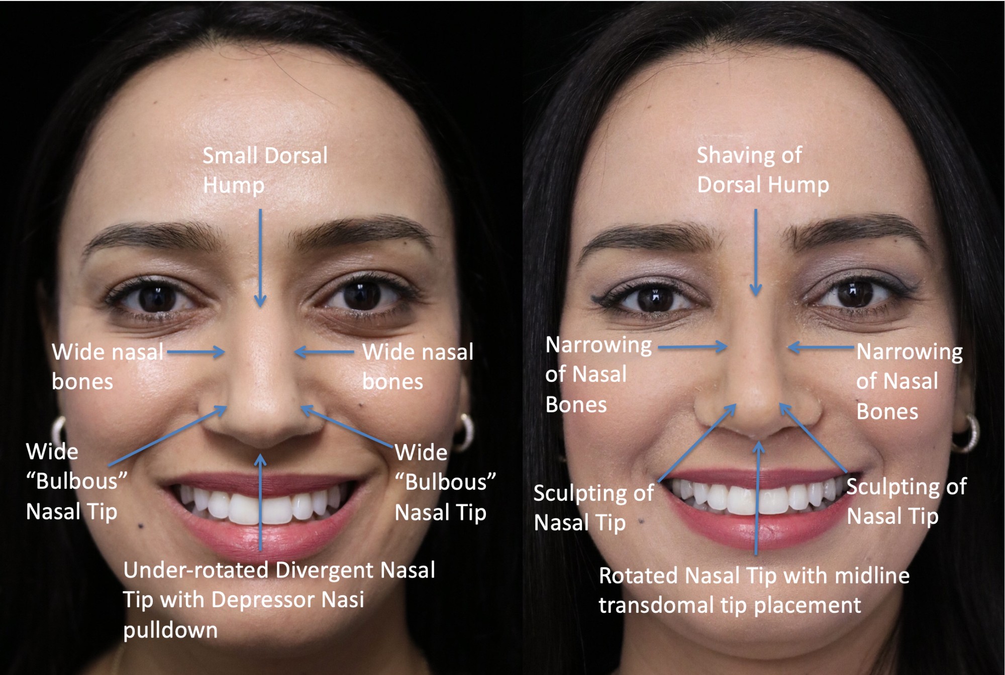 closed rhinoplasty closed rhinoplasty