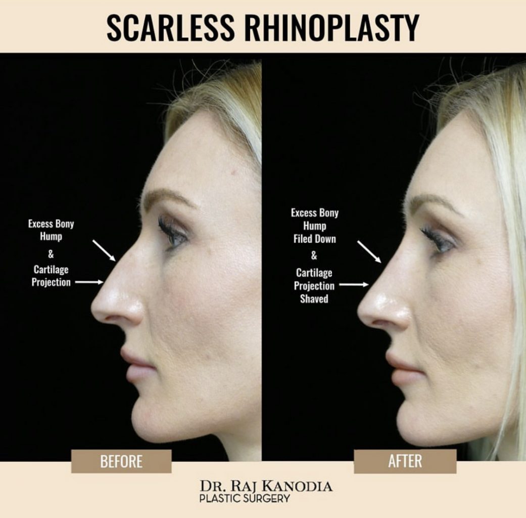closed rhinoplasty closed rhinoplasty
