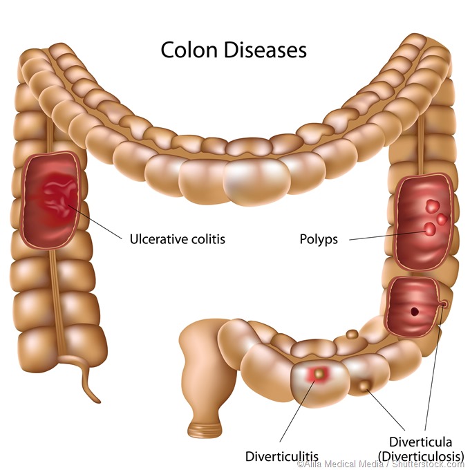 colon operation colon operation