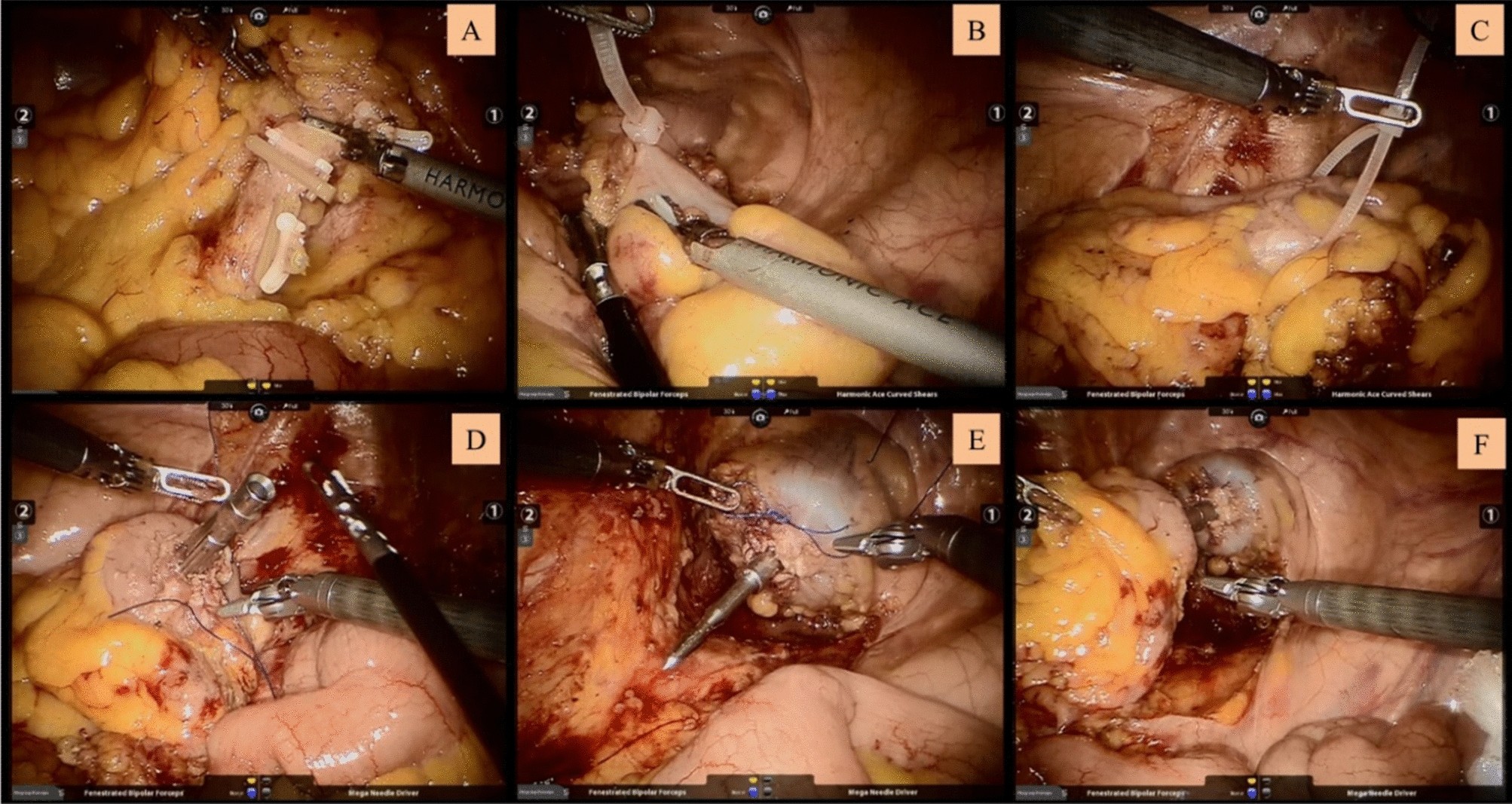colon operation colon operation