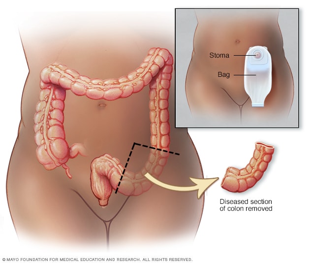 Colon operation: What you need to know about this surgical procedure