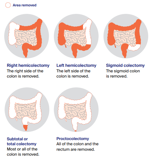 colon operation colon operation