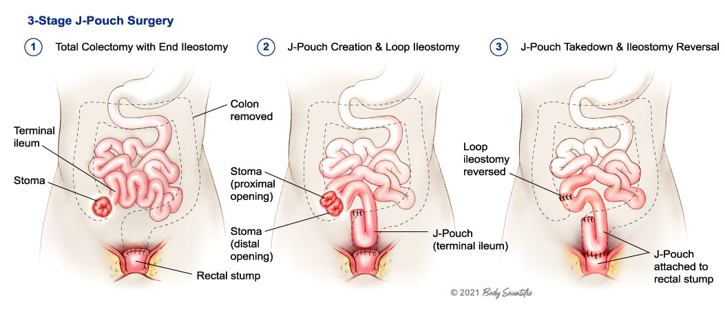 colostomy operation