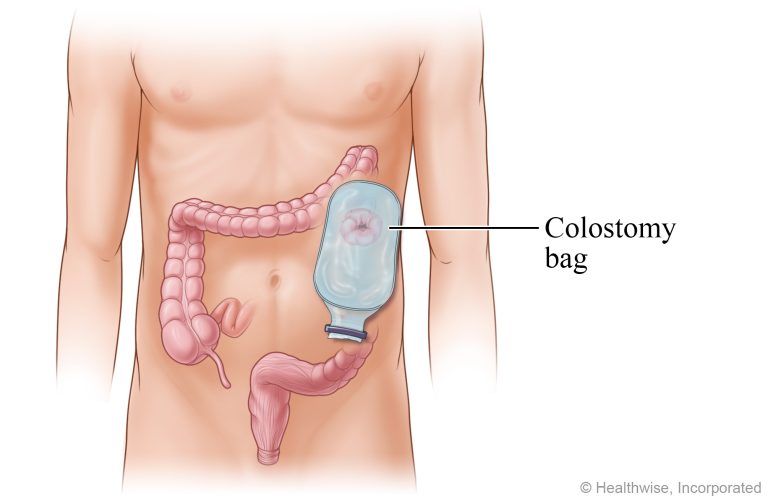 Colostomy operation: Key details and recovery tips