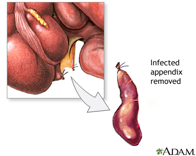surgical removal of the appendix surgical removal of the appendix