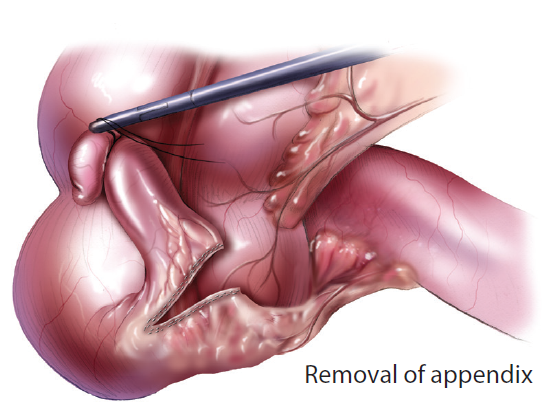 surgical removal of the appendix surgical removal of the appendix