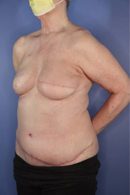 diep breast reconstruction diep breast reconstruction