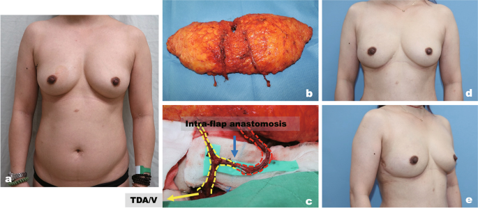 diep breast reconstruction diep breast reconstruction