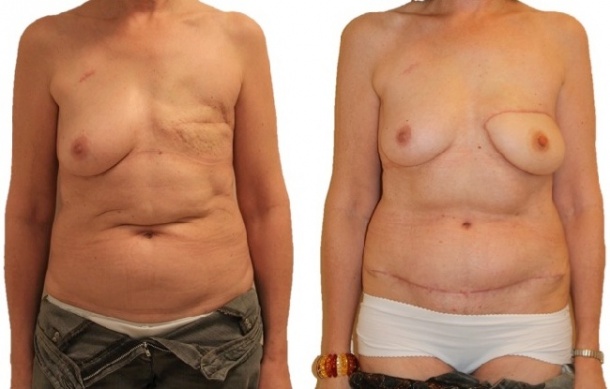 diep breast reconstruction diep breast reconstruction