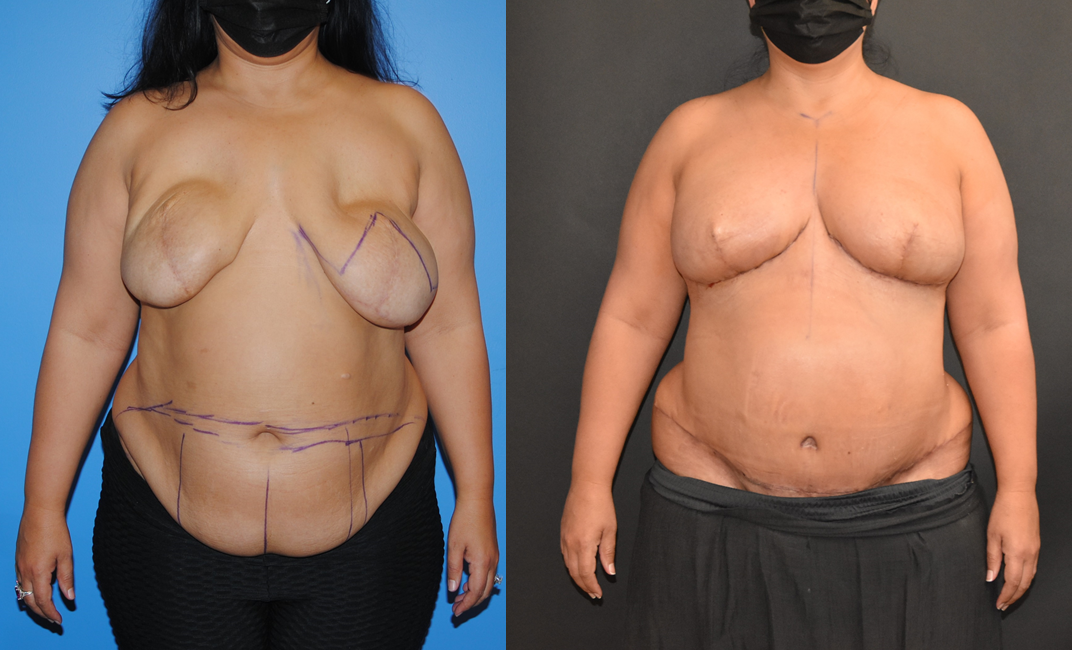 diep breast reconstruction diep breast reconstruction