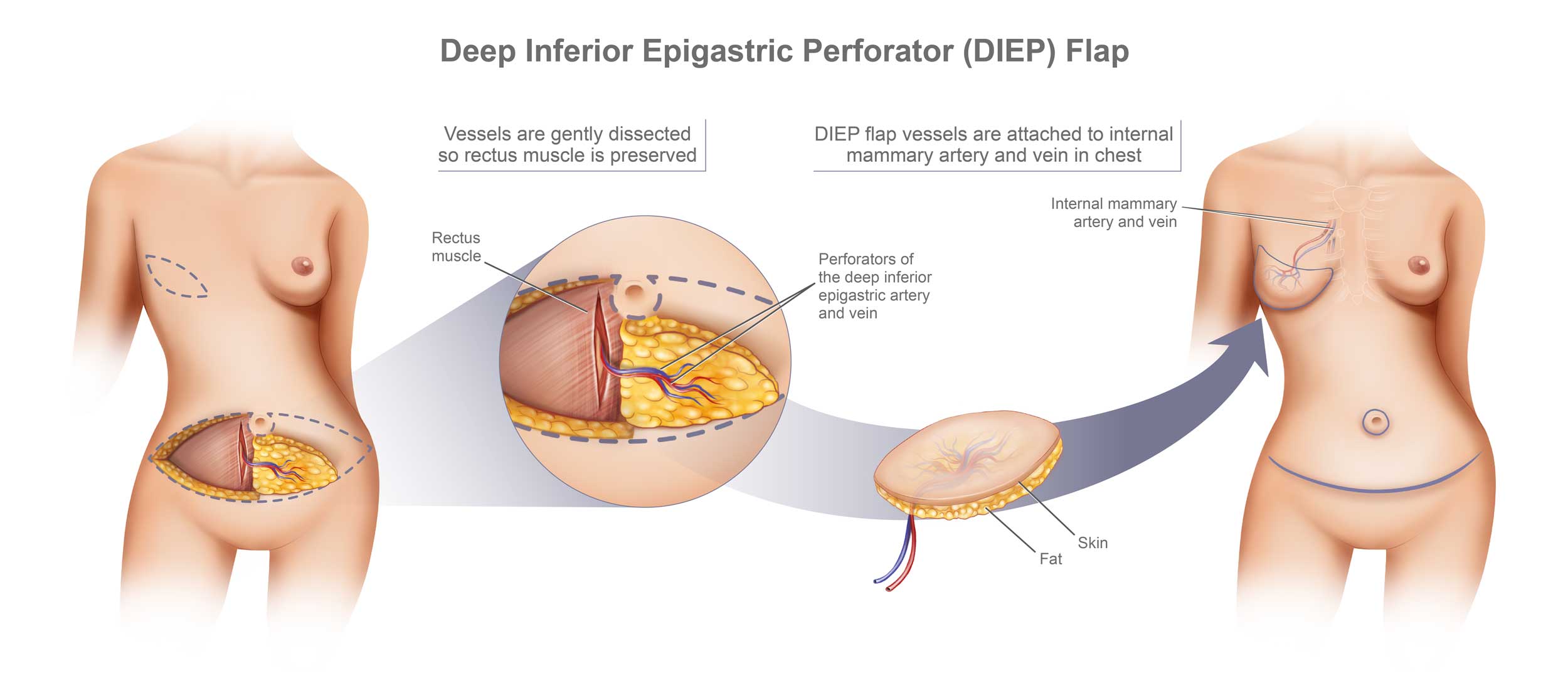 diep flap breast reconstruction diep flap breast reconstruction