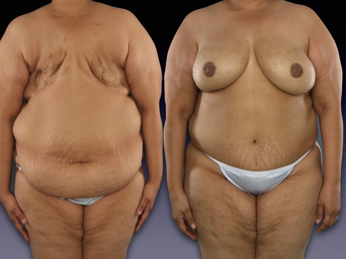 diep flap breast reconstruction diep flap breast reconstruction