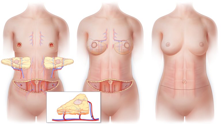DIEP flap breast reconstruction: What you need to know