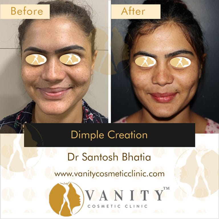dimples surgery dimples surgery