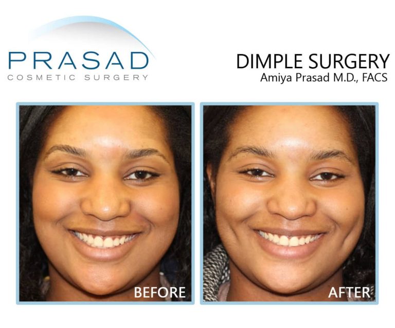 Dimples surgery: Creating natural-looking dimples