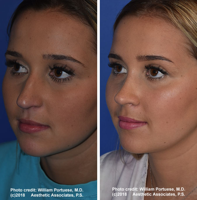 dorsal hump removal cost dorsal hump removal cost