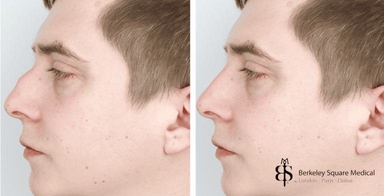 Dorsal Hump Removal Cost: Budgeting for nasal refinement