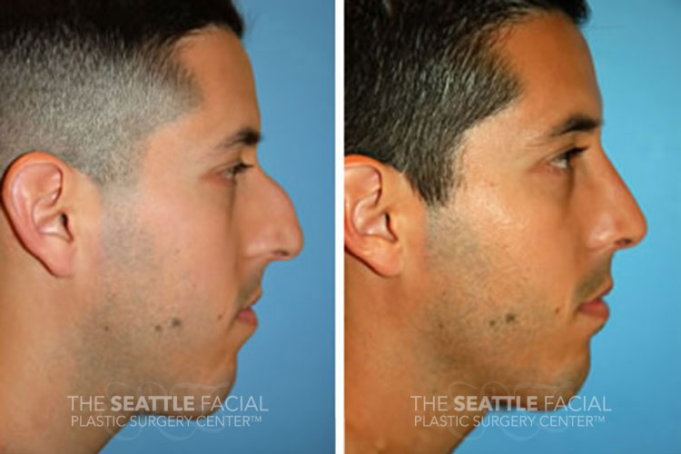 dorsal hump removal cost dorsal hump removal cost
