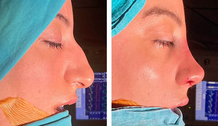 dorsal hump removal cost dorsal hump removal cost