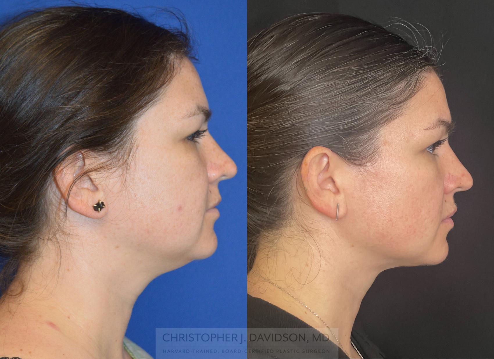 double chin lipo cost double chin lipo cost