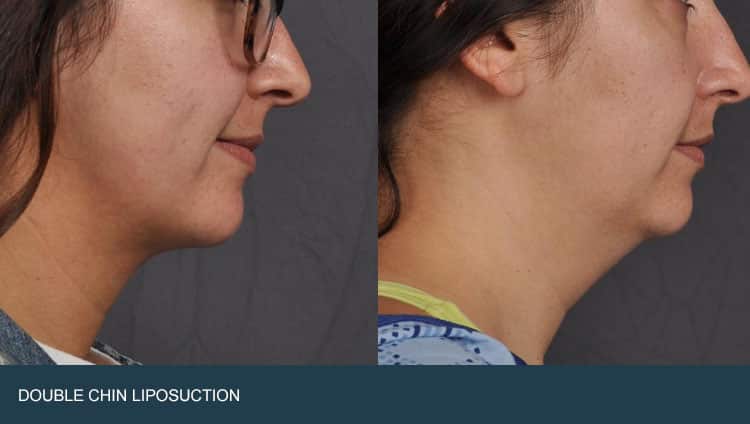 double chin lipo cost double chin lipo cost