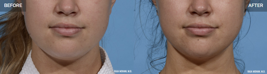 double chin lipo cost double chin lipo cost
