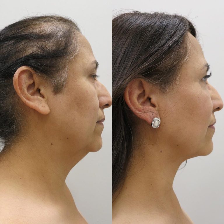 Double Chin Lipo Cost: Eliminating stubborn fat