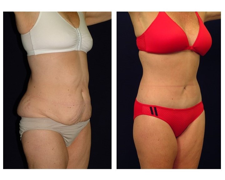 drainless tummy tuck drainless tummy tuck