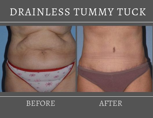 drainless tummy tuck drainless tummy tuck