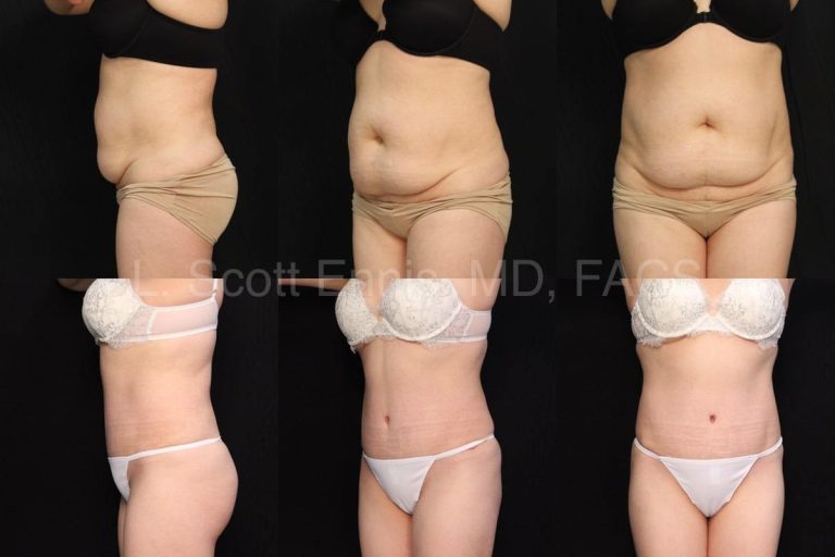 Drainless Tummy Tuck: A modern twist on abdominoplasty