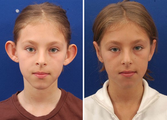 ear plastic surgery ear plastic surgery