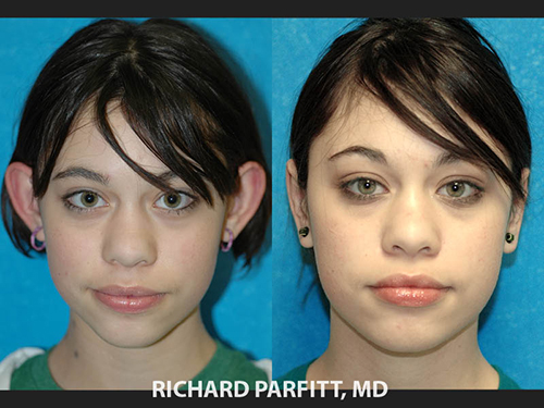 ear plastic surgery ear plastic surgery
