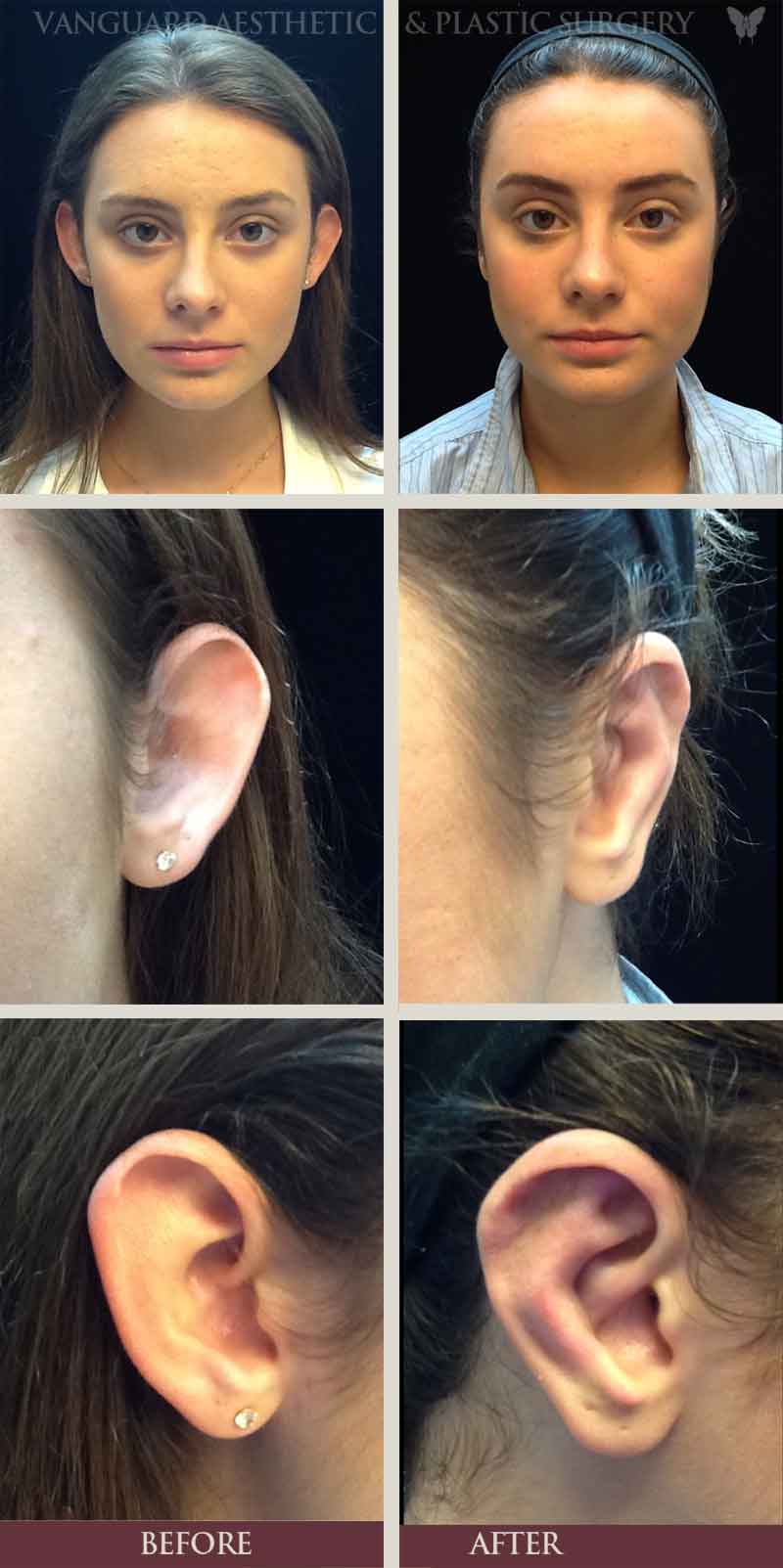 ear plastic surgery ear plastic surgery