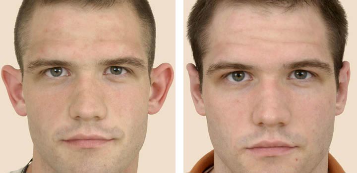 Ear plastic surgery: Solutions for reshaping and repair