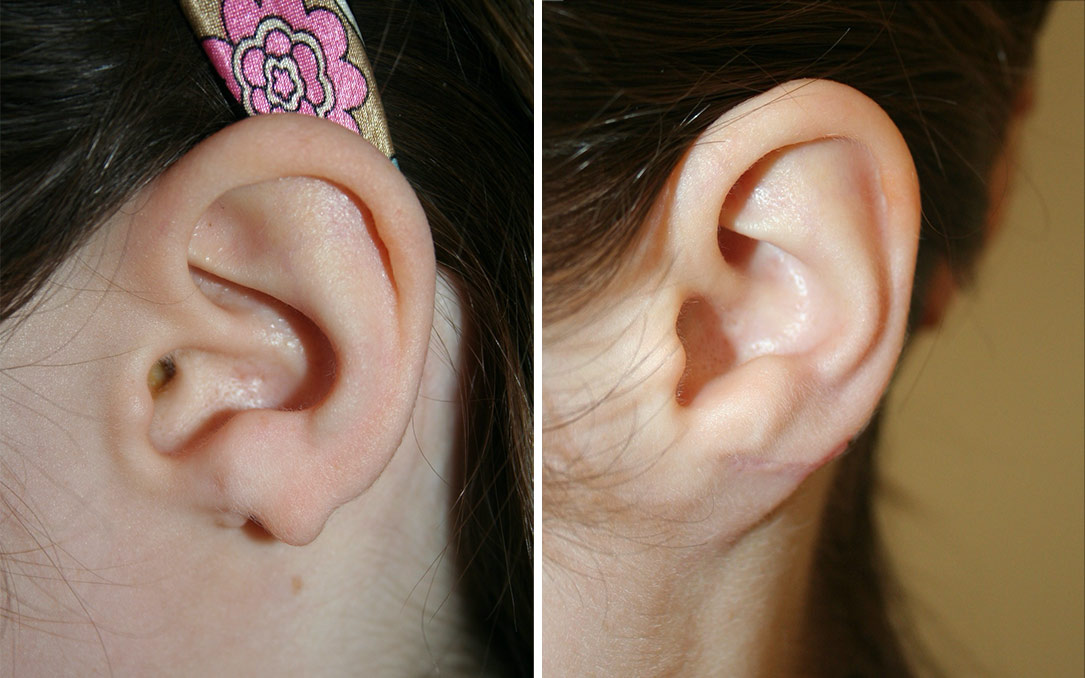 ear reconstruction surgery ear reconstruction surgery