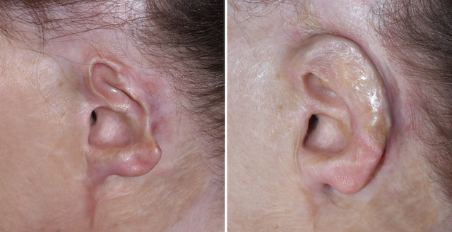 ear reconstruction surgery ear reconstruction surgery